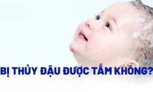 Bị thủy đậu có được tắm không?