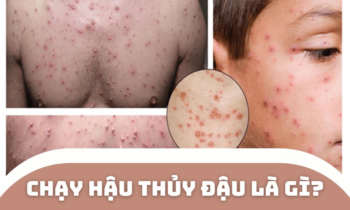 Chạy hậu thủy đậu là gì?