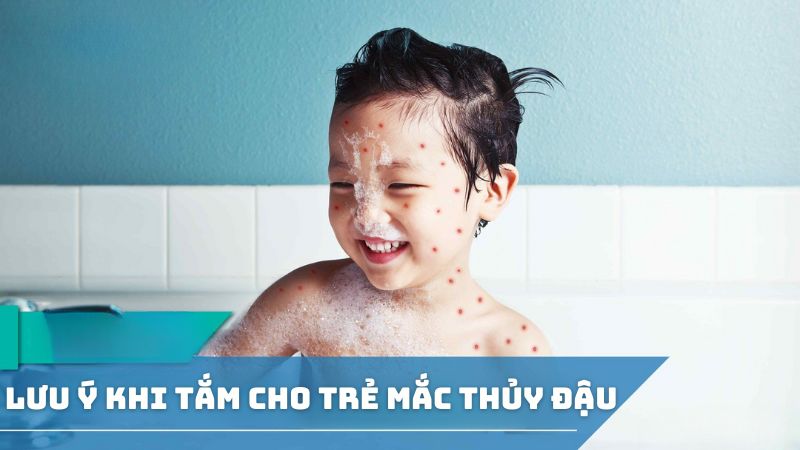 Lưu ý khi tắm đối với trẻ mắc thủy đậu