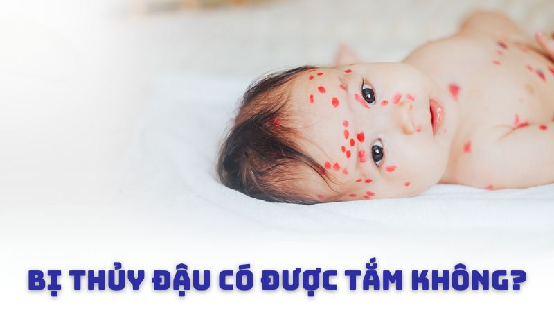 Bị thủy đậu có được tắm không?