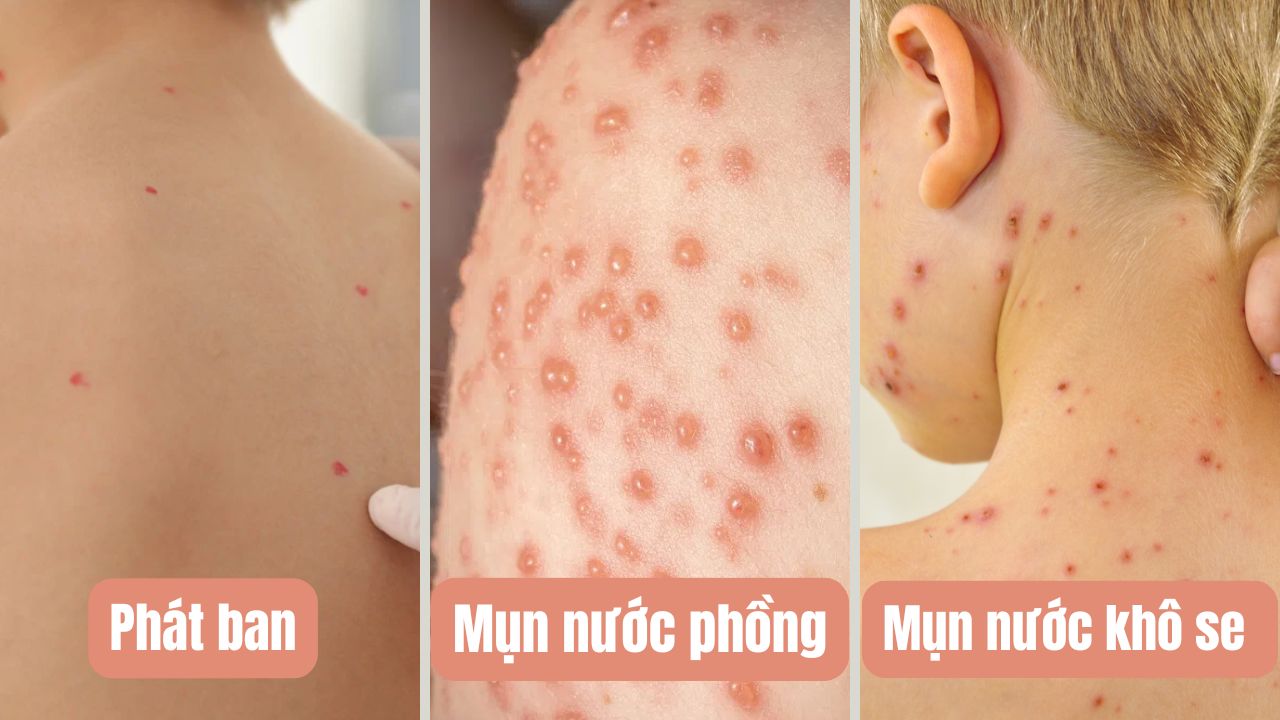 Bệnh thủy đậu là gì?