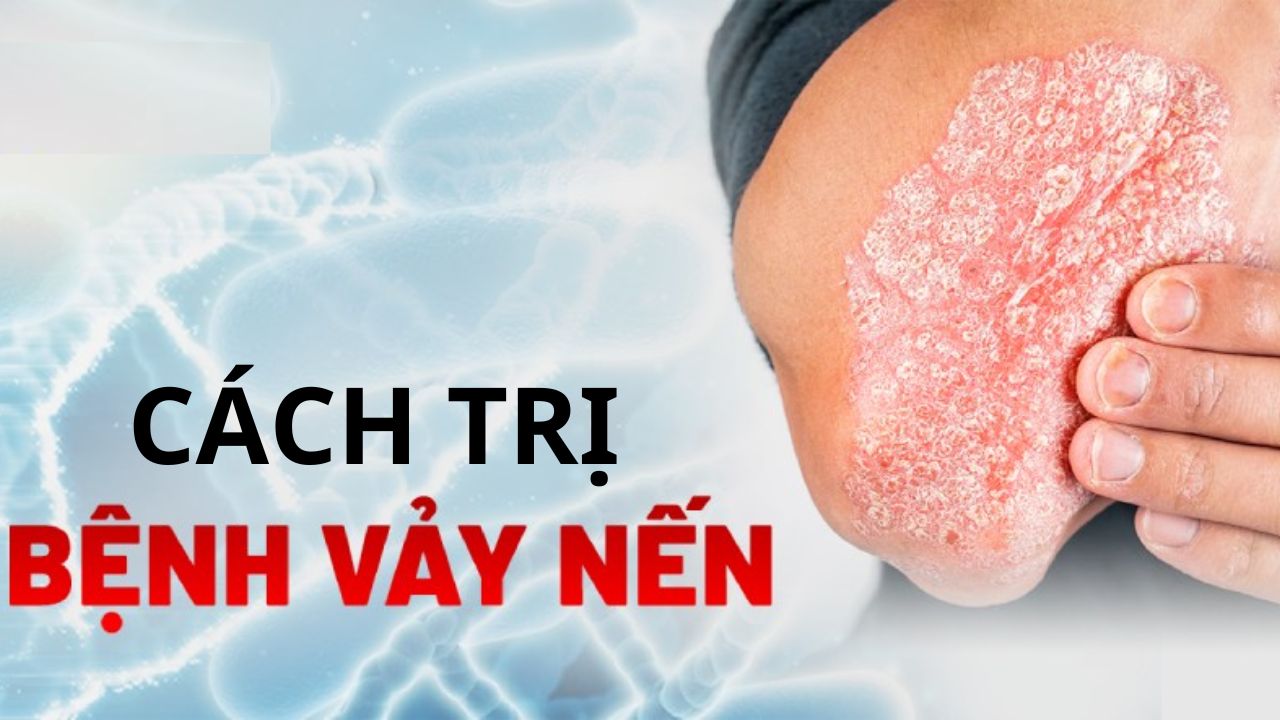 10 cách trị bệnh vảy nến hiệu quả, phổ biến nhất hiện nay