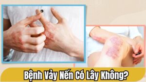 Bệnh vảy nến có lây không? Biến chứng do bệnh vảy nến để lại