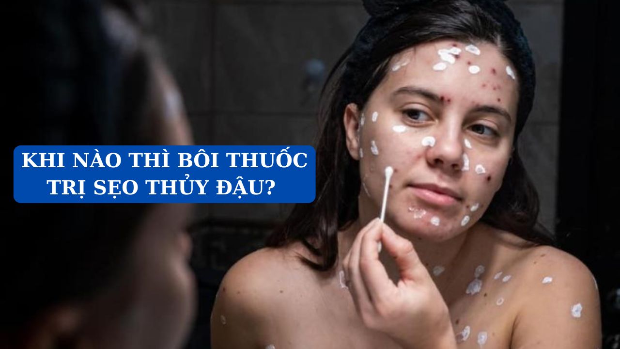 Khi nào thì bôi thuốc trị sẹo thủy đậu tốt nhất?