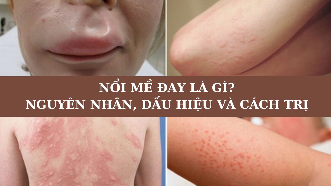 Nổi mề đay là gì? Nguyên nhân, dấu hiệu và cách trị hiệu quả