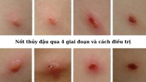 Hình ảnh nốt thủy đậu qua 4 giai đoạn và cách điều trị hiệu quả