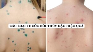 Các loại thuốc bôi thủy đậu an toàn, hiệu quả