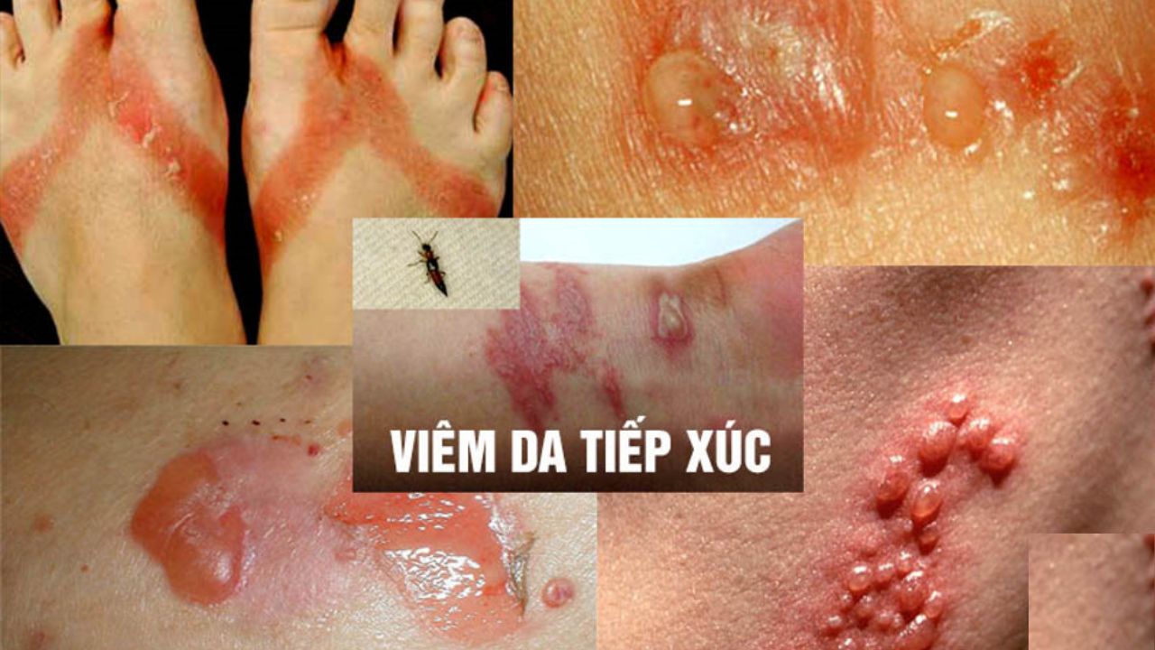 Viêm da tiếp xúc có nhiều triệu chứng khác nhau