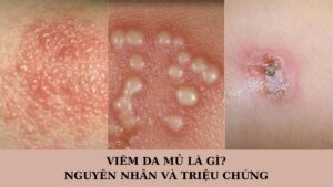 Viêm da mủ là gì? Nguyên nhân và triệu chứng thường gặp