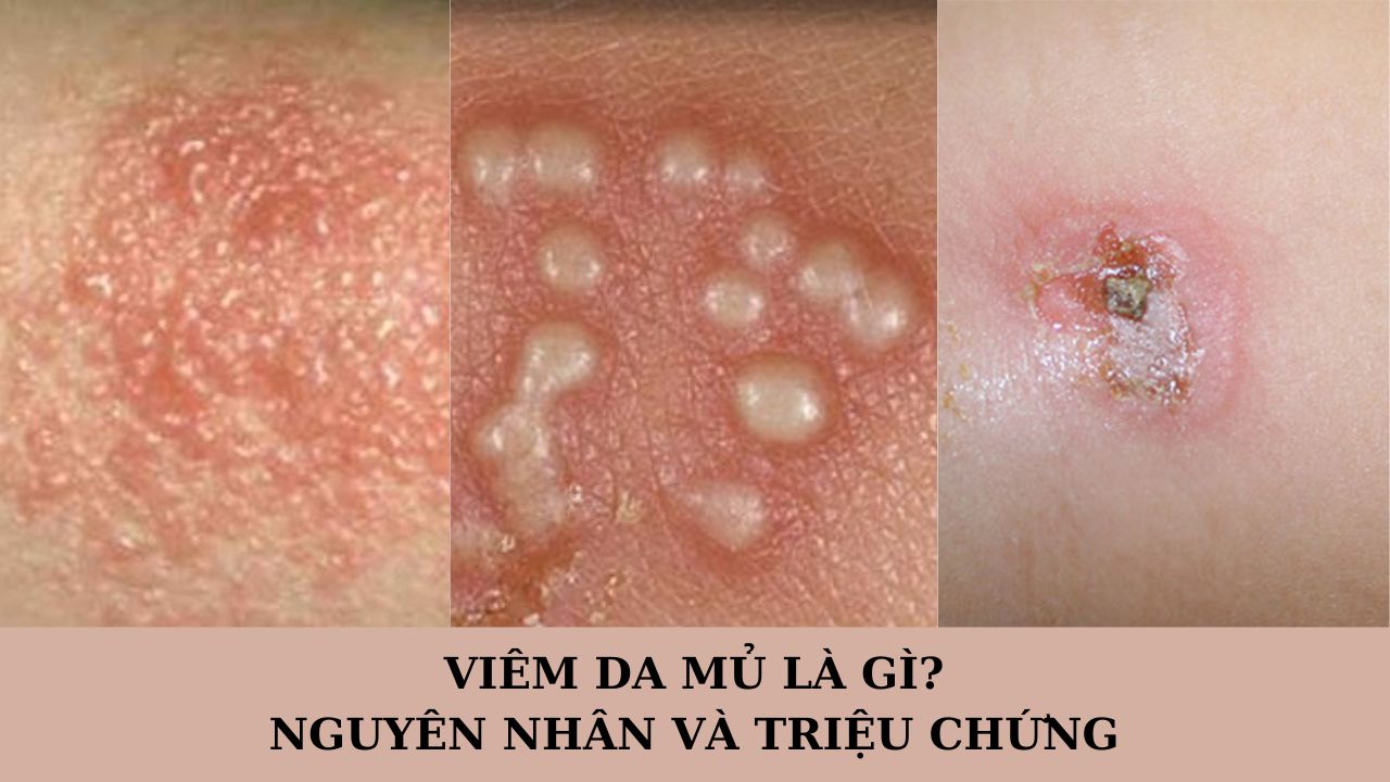 Viêm da mủ là gì? Nguyên nhân và triệu chứng thường gặp