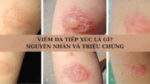 Viêm da tiếp xúc là gì? Nguyên nhân và triệu chứng phổ biến